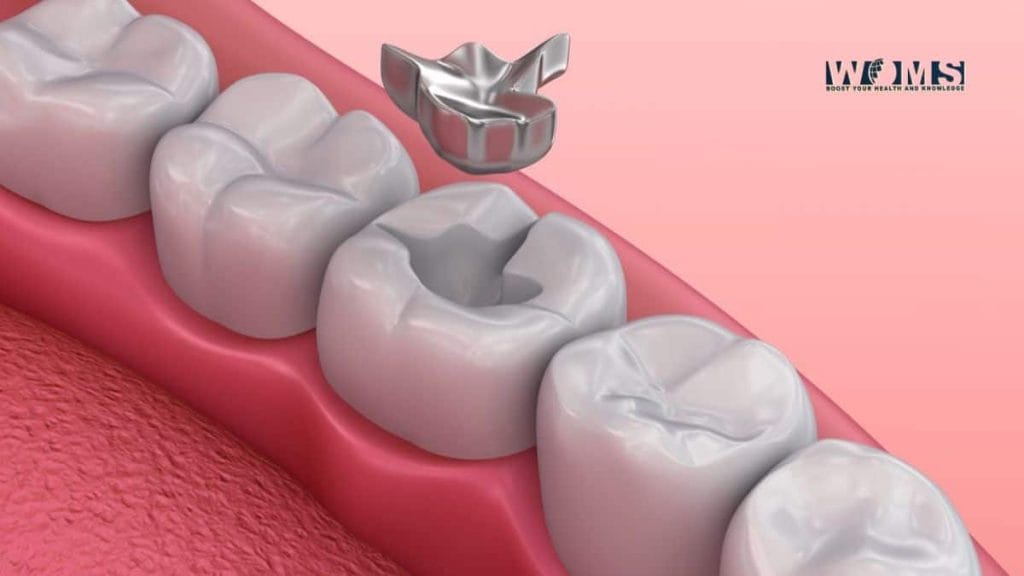 Should I Have My Amalgam Fillings Replaced? WOMS