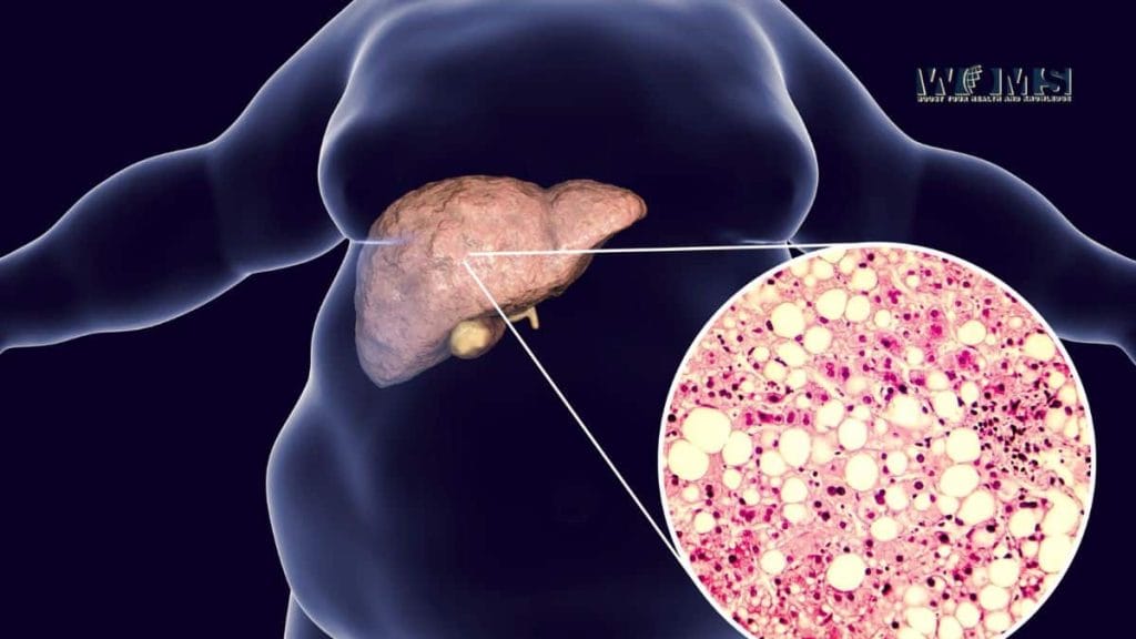 How to Prevent a Liver Failure - WOMS