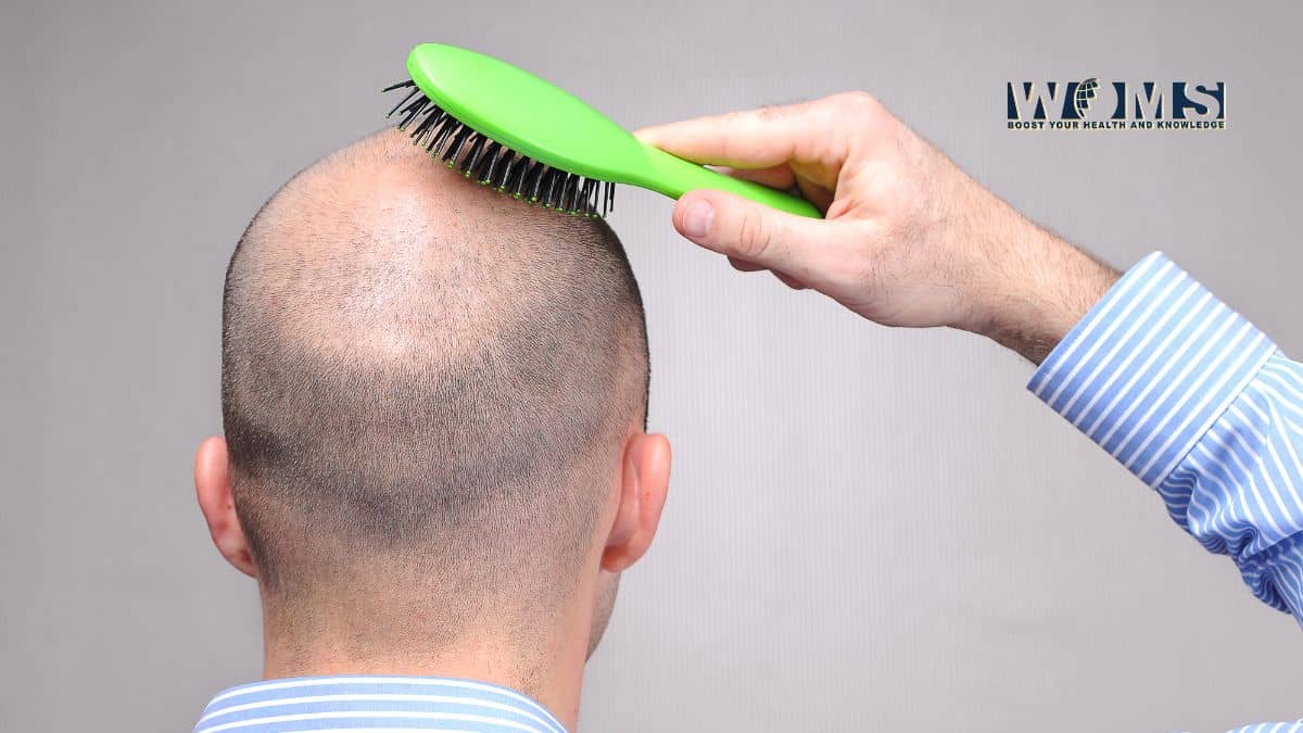 Hair Loss in Men