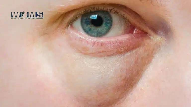 Swollen Tear Duct Causes Symptoms And Treatment Woms