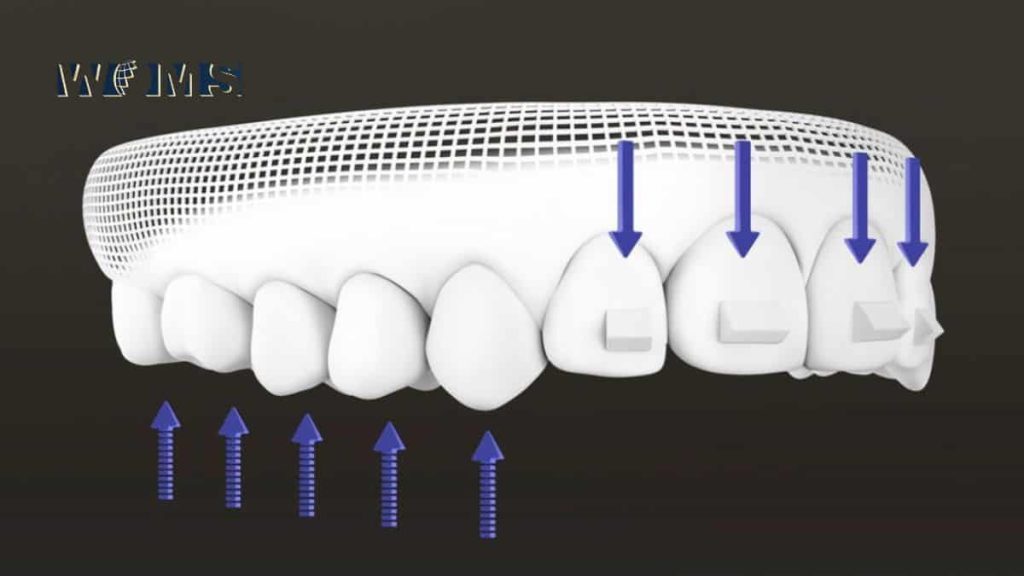 Invisalign attachments are fixed directly on to the tooth using composite bonding material.
