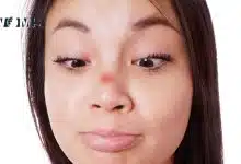 Pimple Nose