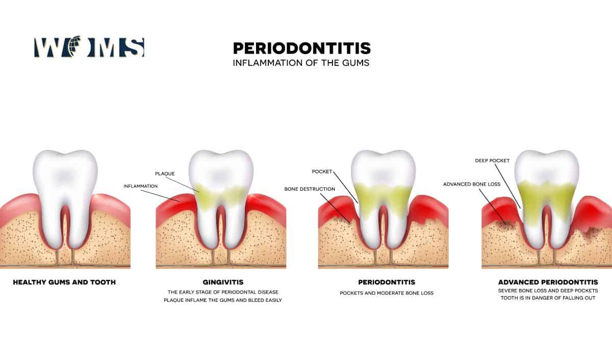 Stages of gum disease