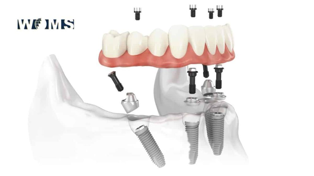 All-on-4  involves the placement of four dental implants into the jaw, which hold a tooth bridge of up to 12 teeth in place.