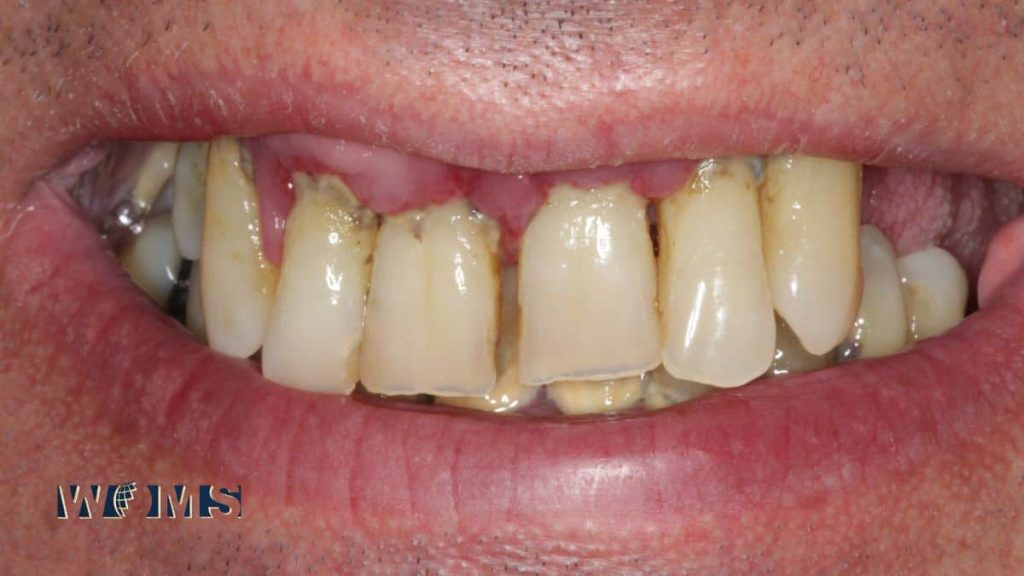 Patient’s natural teeth are nearing the end of their lifespan
