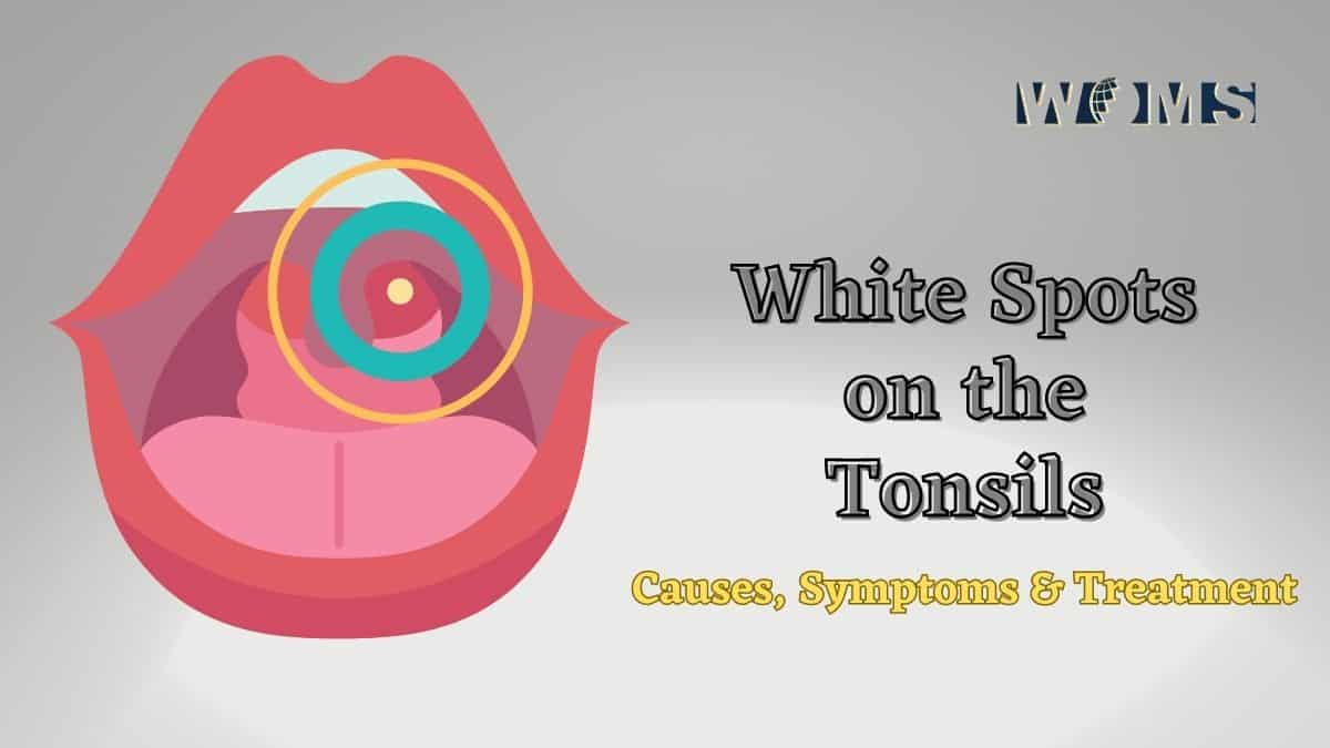 White Spots on the Tonsils Causes, Symptoms and Treatment