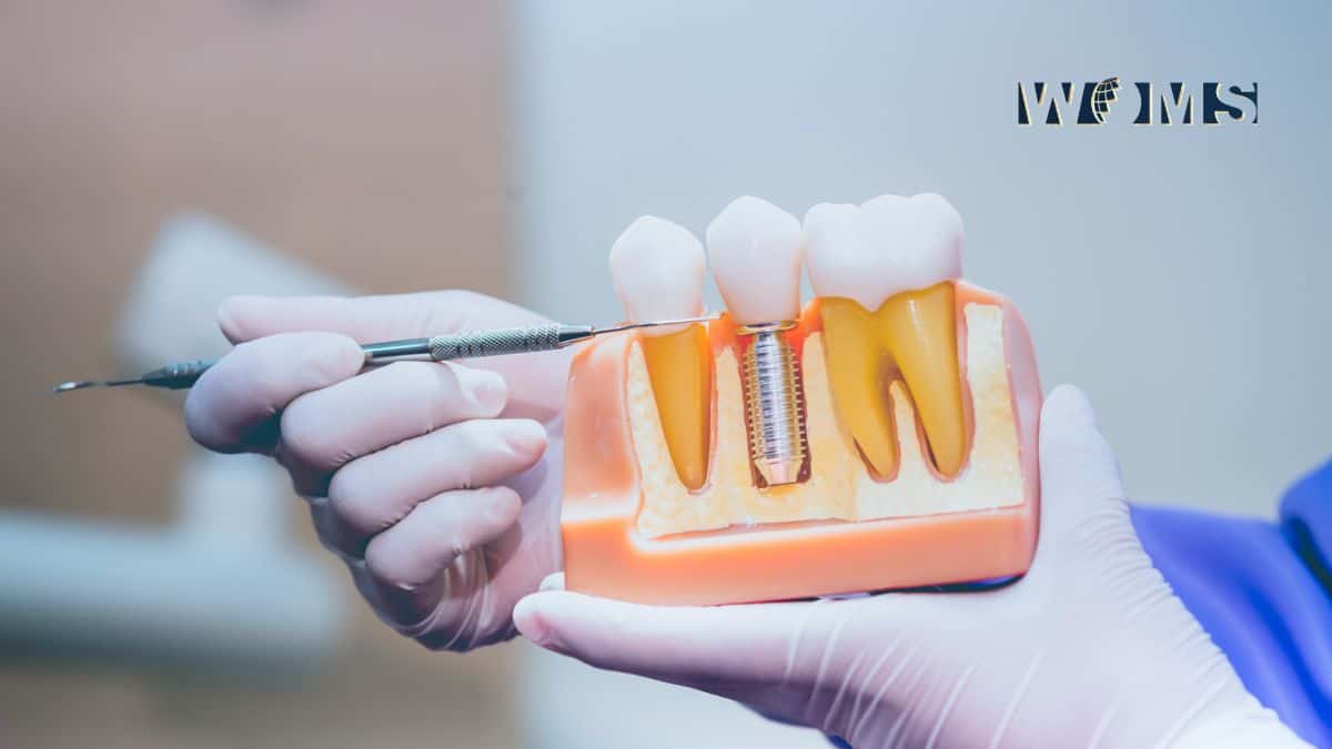 What To Do Before And After Getting Dental Implants 