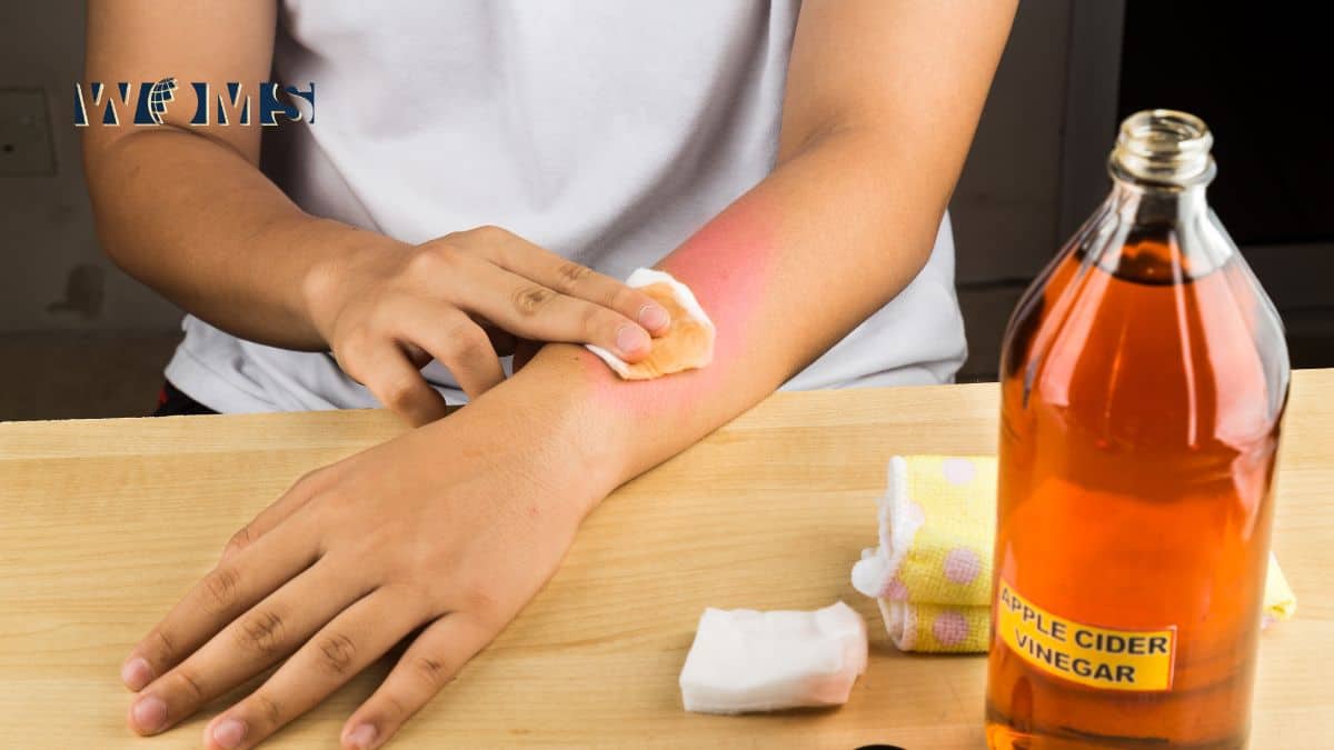 Apple Cider Vinegar for Warts