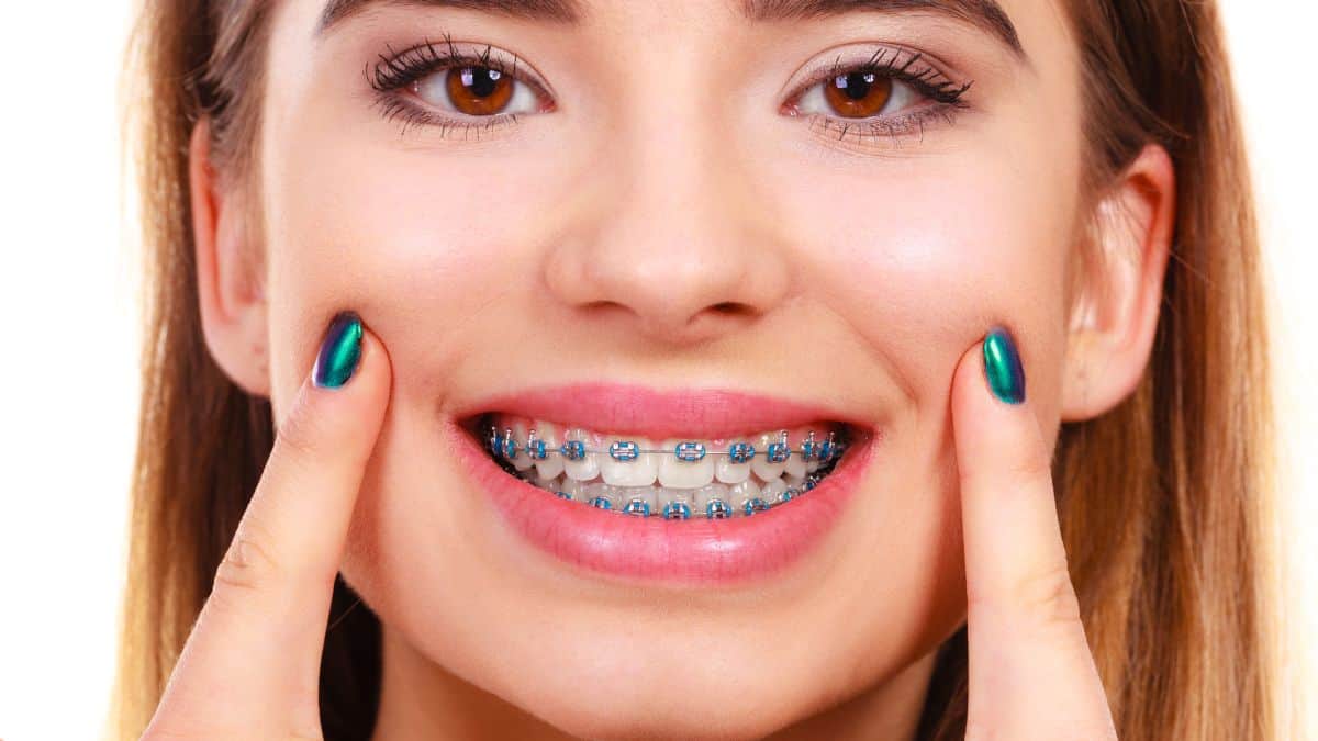 Different Types of Braces