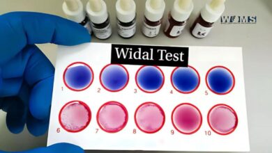 Widal Test for Typhoid