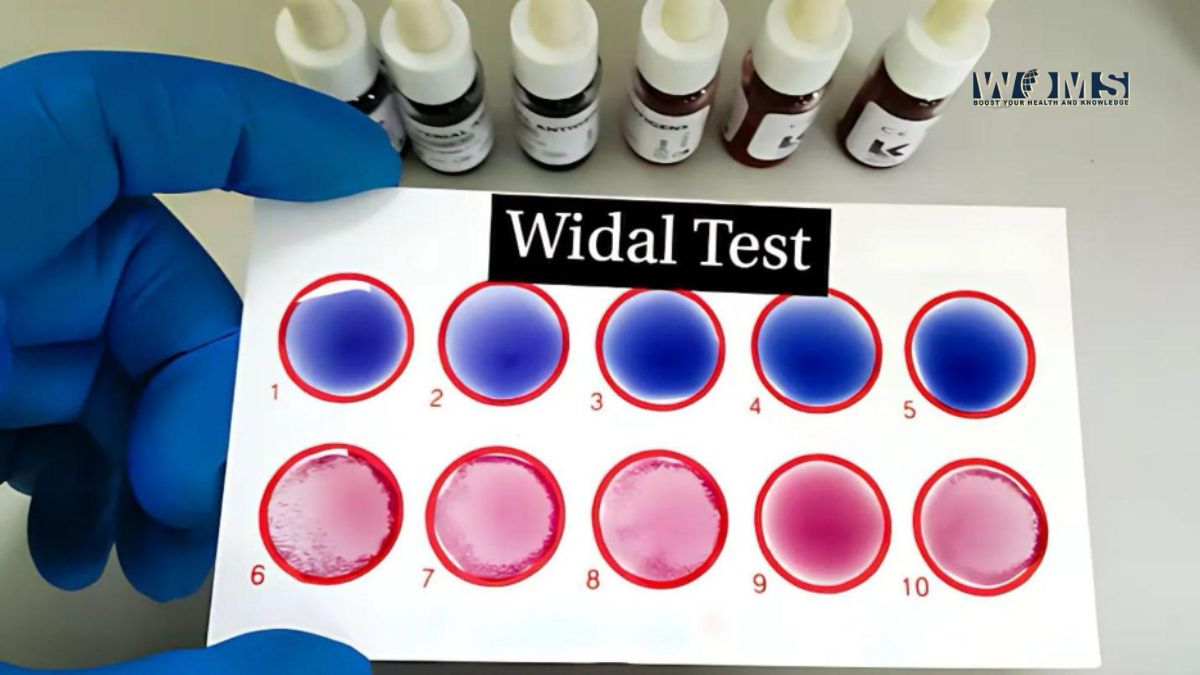 Widal Test for Typhoid