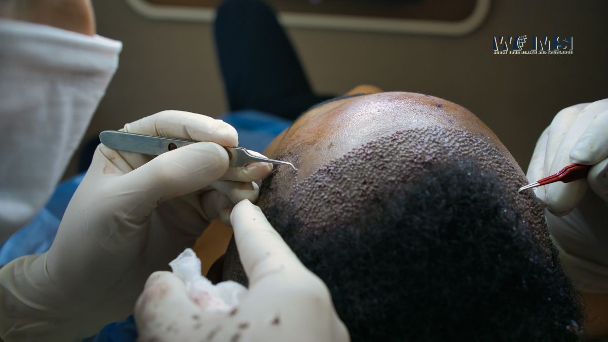Afro Hair Transplant