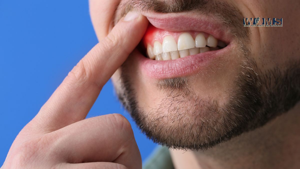 Periodontal Disease